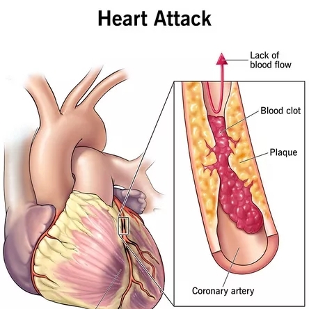 The Three Pillars Of A health Diet That Shall Protect You Against Heart Diseases.