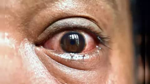 YOU CAN CONTACT SYPHILIS IN YOUR EYES IF YOU ENGAGE IN THESE THREE THINGS.